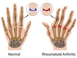 a rheumatoid arthritis fáj az ízületekre)